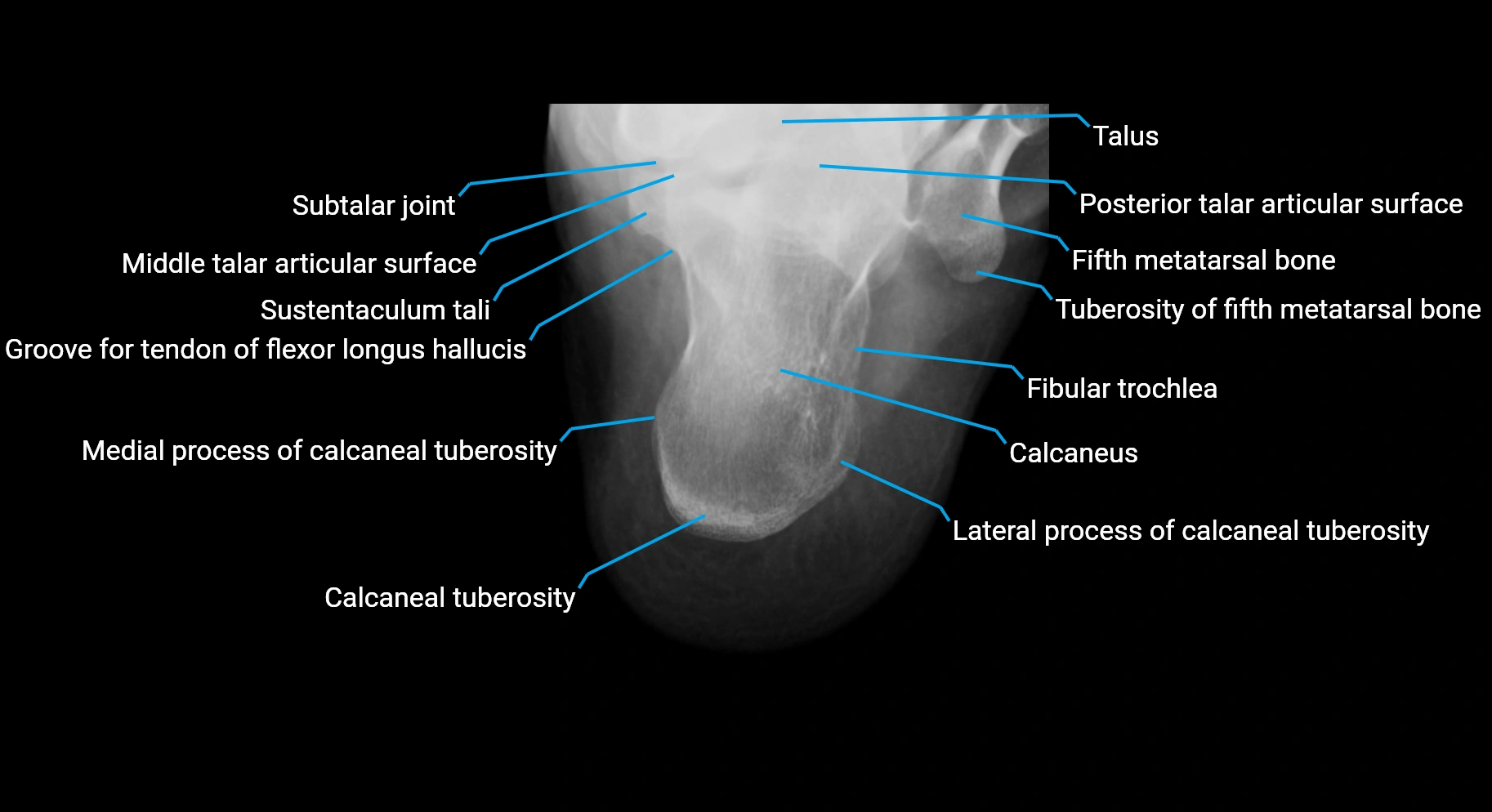 x ray  calcanus AP anatomy labelled image.webp